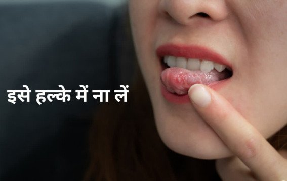 बार-बार मुंह में छाले?