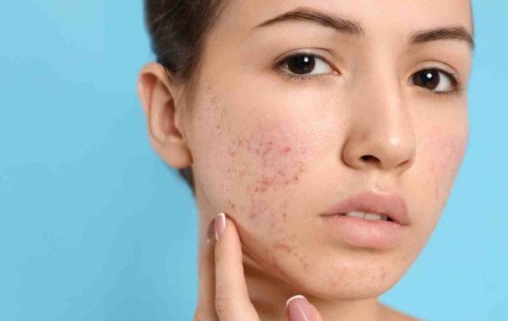 मुंहासे क्यों बार-बार आते हैं?