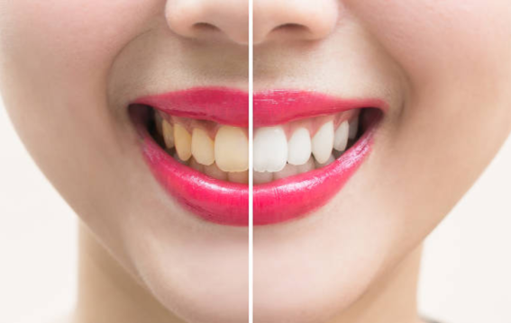 दाँत पीले होने के पीछे छिपे वैज्ञानिक कारण जानिए