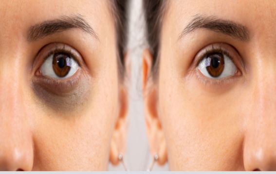 आंखों के काले घेरे कैसे हटें?