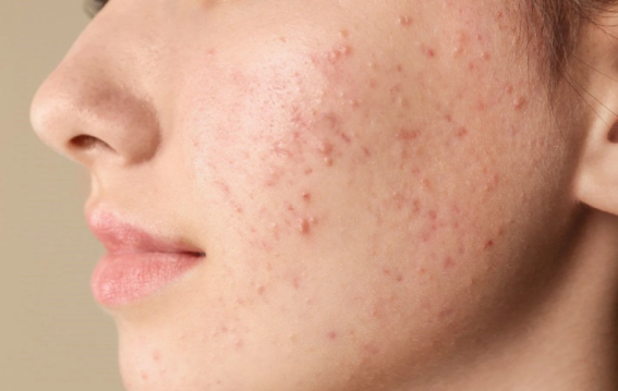 30 की उम्र के बाद भी हो रहे हैं पिंपल्स?