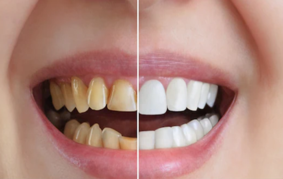 नींबू और नमक से दूर करें दांतों का पीलापन,