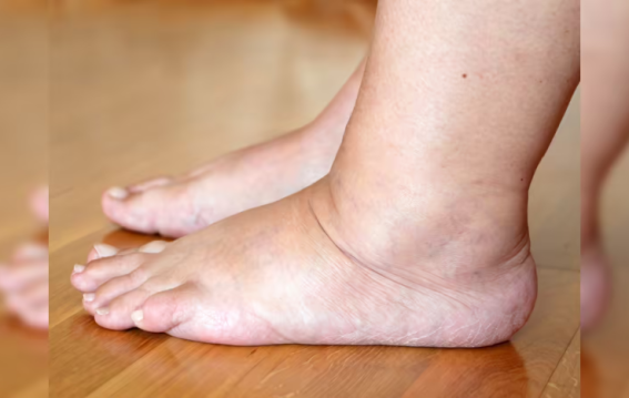 पैरों की सूजन से बढ़ रहा फैटी लिवर