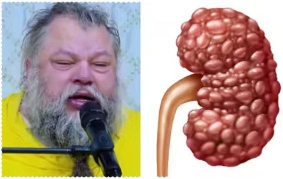 5 लक्षण बताएं, पहचानें प्रेमानंद महाराज वाली बीमारी, बचाव तरीका