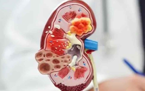 एक किडनी पर जीवन कितना